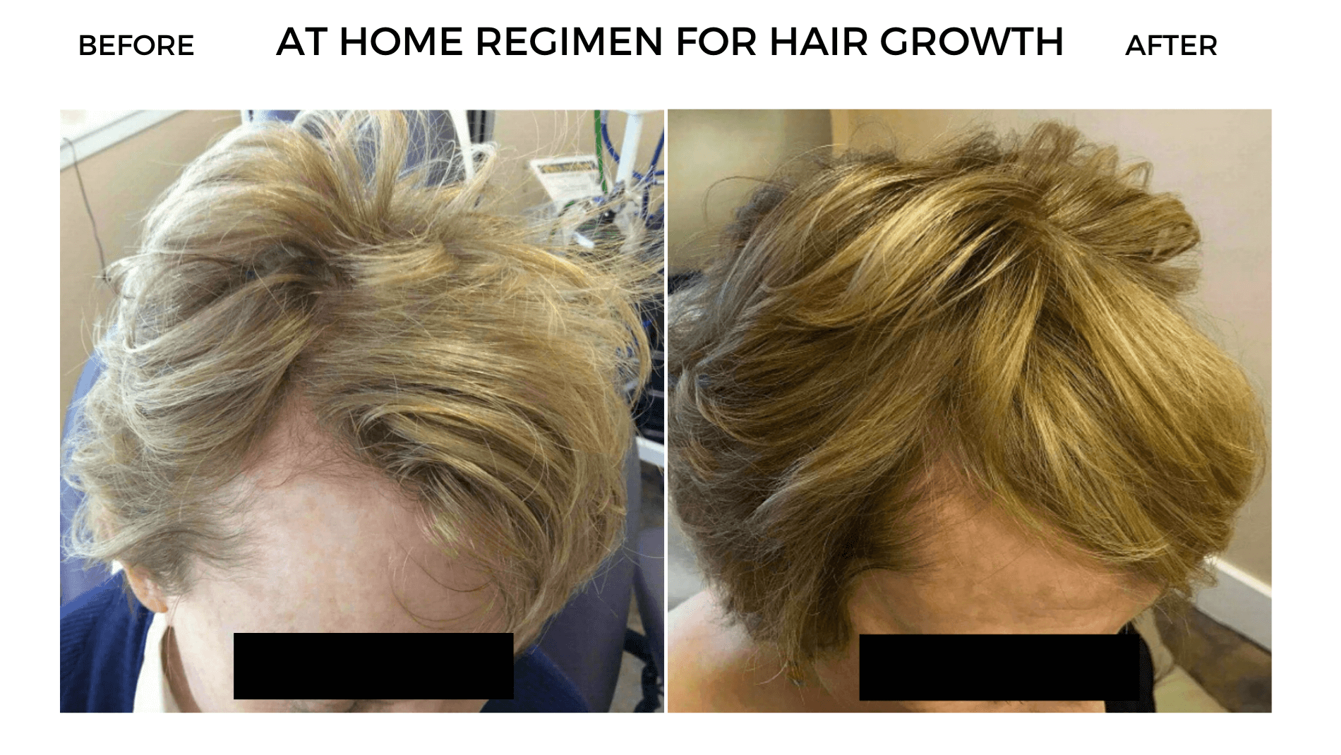 Hair Growth